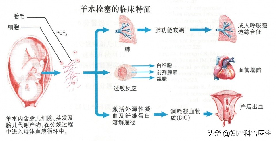 羊水栓塞4大杀手,孕妇哪些原因导致羊水栓塞