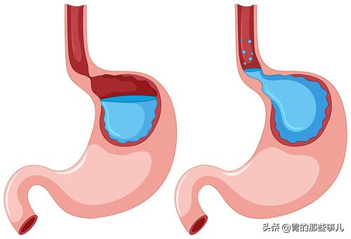 儿童慢性胃炎怎么能彻底治愈,儿童慢性胃炎怎么治疗好得快