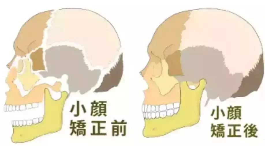 日式小颜整骨合法吗,日式小颜整骨可以维持多久