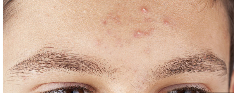 额头长痘丹栀逍遥丸治疗痘痘吗,额头总是长痘痘还有痘印怎么办