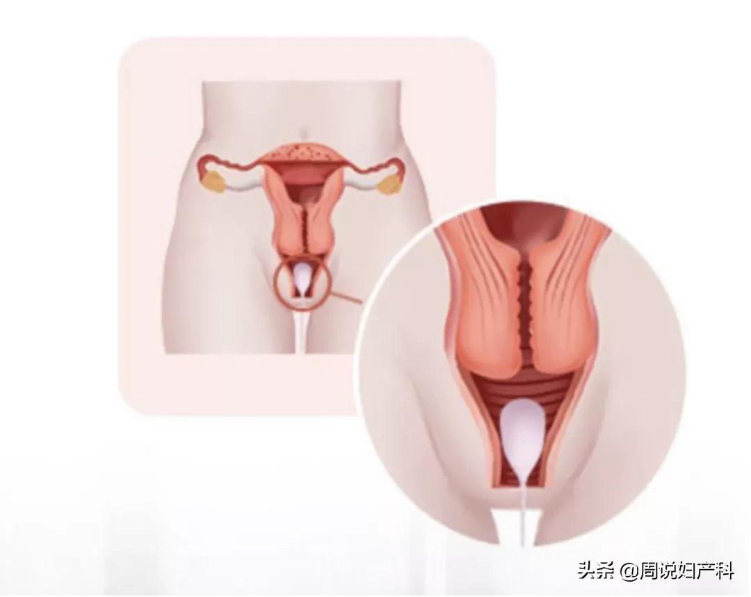 生完孩子憋不住尿怎么办,生完孩子憋不住尿怎么回事