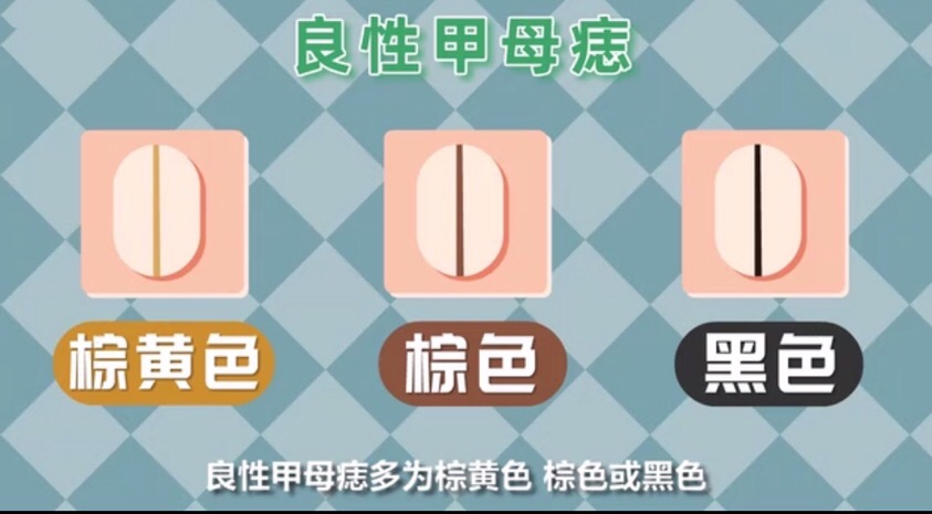 手指甲黑线怎么看是不是黑色素瘤,指甲有甲母痣会癌变吗