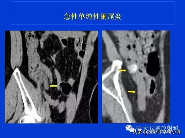 阑尾炎课件,阑尾炎的超声课件