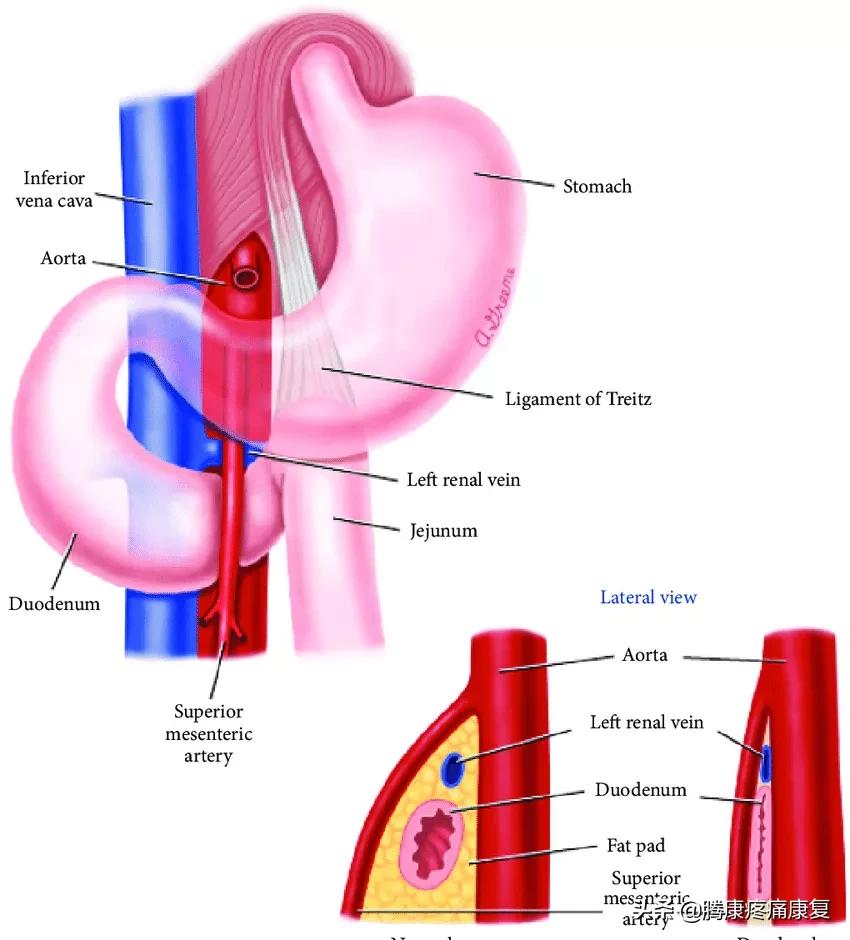 肠系膜上动脉综合征治疗,肠系膜上动脉综合征ct表现