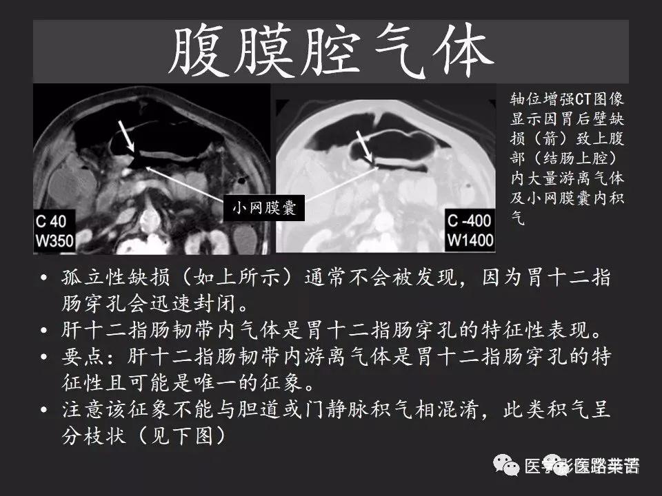 空腔脏器穿孔和胃肠道穿孔区别,腹膜后穿孔一般是哪里穿孔