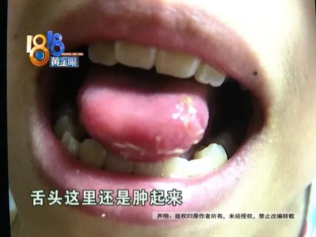 补牙把舌头下面划了一个洞,在小诊所补牙被扎舌头