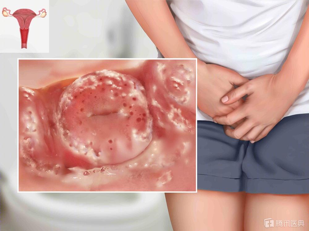 妇科炎症反复发作医生说尽快怀孕,妇科炎症老是反复男的怎么治疗