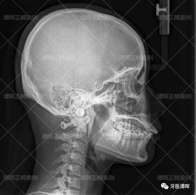 门牙前突+牙齿不齐矫正案例分享