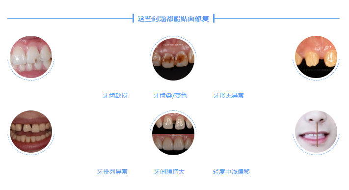 树脂贴面和烤瓷贴区别,贴面树脂的好还是烤瓷的好