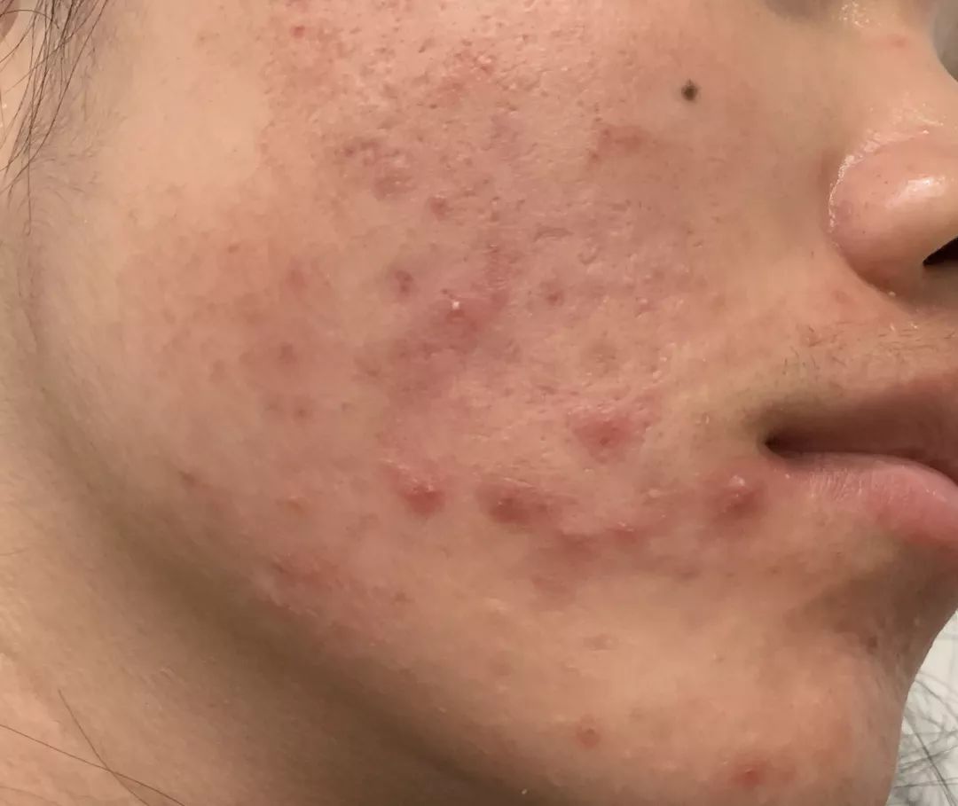 异维a酸软胶囊治疗痘痘多久见效,异维a酸抑制雄性激素治疗痘痘吗