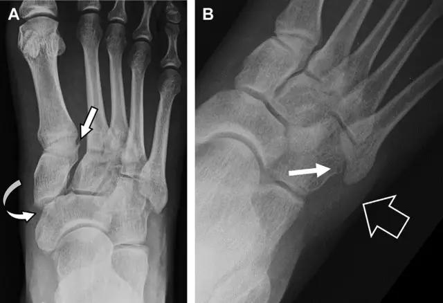 放射科夜班病例大全,放射科容易漏诊的骨折