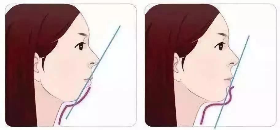 “龅牙”是深覆颌还是深覆盖,两者如何区分?