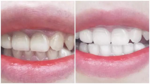 刷牙去牙垢烟垢黄牙最有效方法,刷牙多久才能消除牙黄味