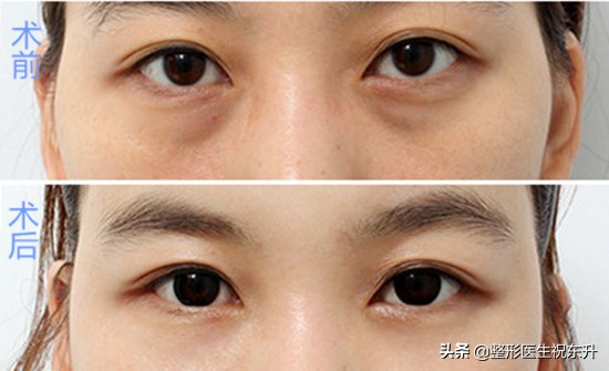 消除脂肪型眼袋的最好方法,治眼袋脂肪最好方法