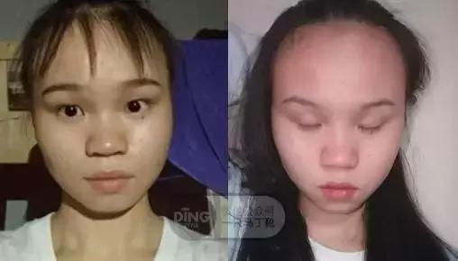 颅顶太低如何自救,颅顶低怎么自救