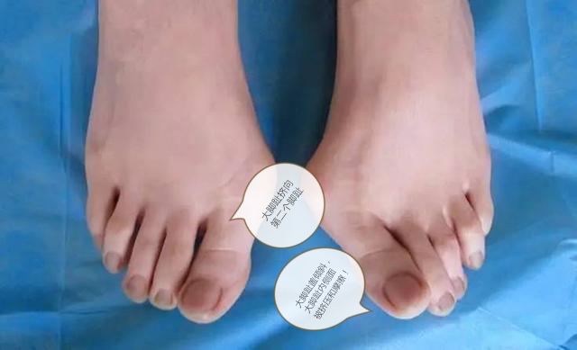 大脚趾外翻怎么锻炼恢复正常,大脚趾外翻矫正危害