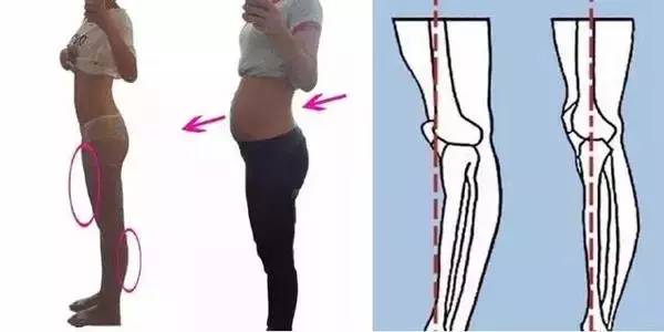 膝反屈的治疗方法,膝反屈是什么意思