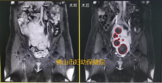 子宫肌瘤病例分享ppt,超声聚焦子宫肌瘤消融术