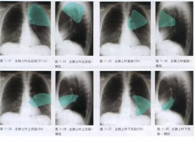 详细的胸部X线解剖，最基础最实用！