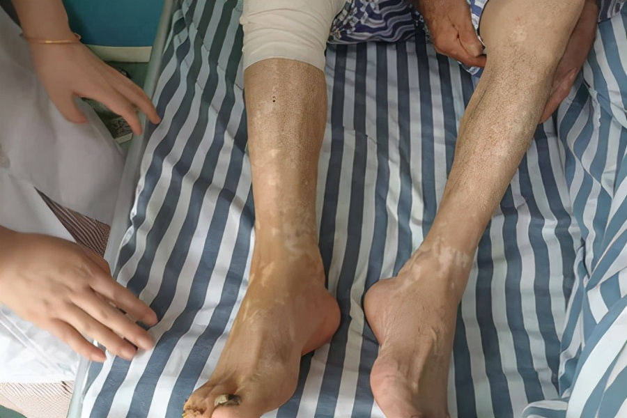 为什么会患类风湿，这些发作诱因你中招了吗？