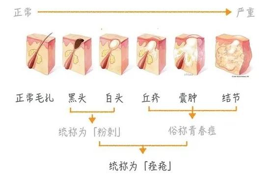 鼻子上的黑头的正确处理方法,鼻子上的黑头越来越严重怎么办
