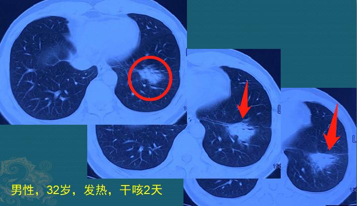 年轻人肺炎出院，花了3万：如果时光倒流，我不去那个养鸡场