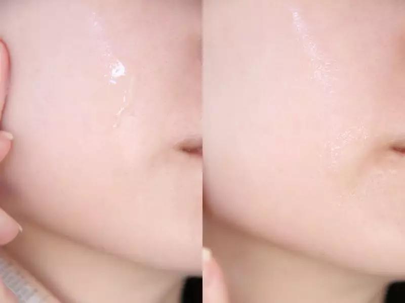 祛痘淡斑美白神器,2毛钱淡斑