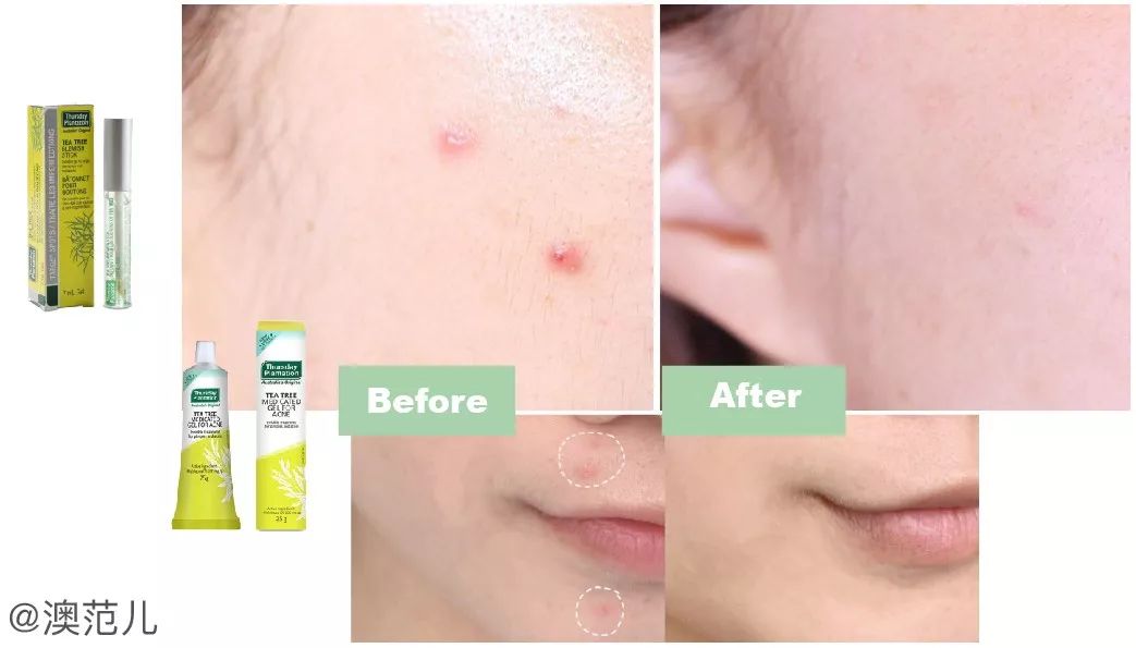 手持挤痘痘神器,挤痘神器单头