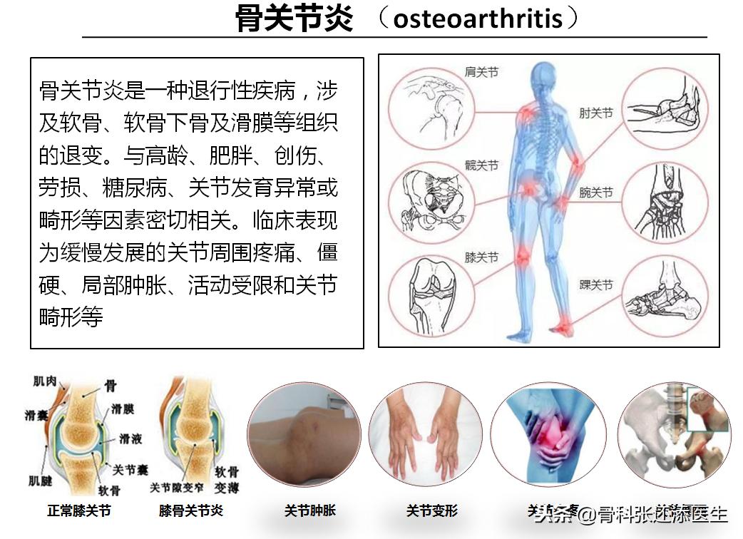 膝盖疼应该补充健力多哪种氨糖,膝关节痛是吃氨糖还是钙片好