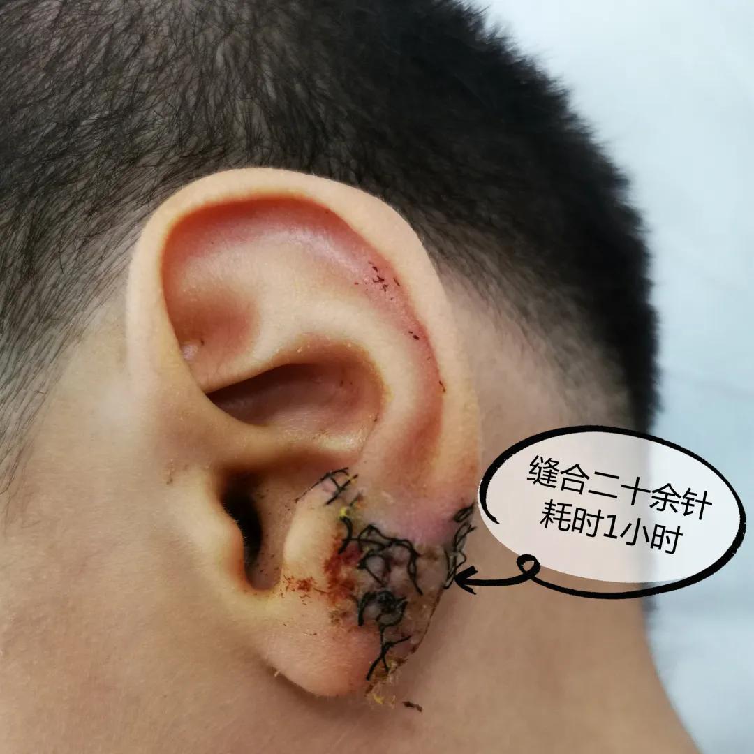 小孩耳垂根部裂开一道口子,孩子耳垂裂开了一条缝