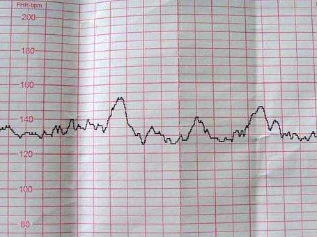 产检b超单上有个x,产检b超单医生都收回去吗