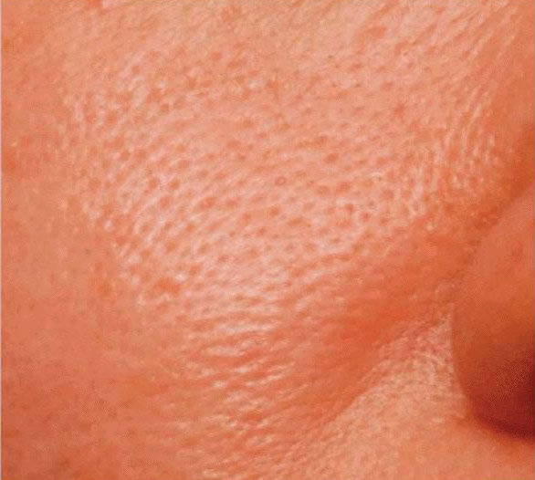 毛孔粗大抗炎,油脂性毛孔粗大怎么抗老