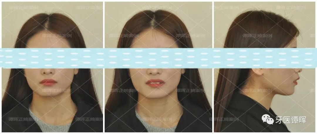 门牙前突+牙齿不齐矫正案例分享