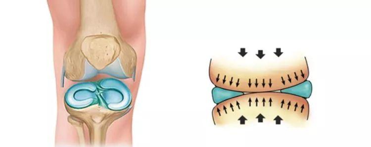 半月板损伤的成因和预防策略,关于半月板损伤的临床表现及诊断