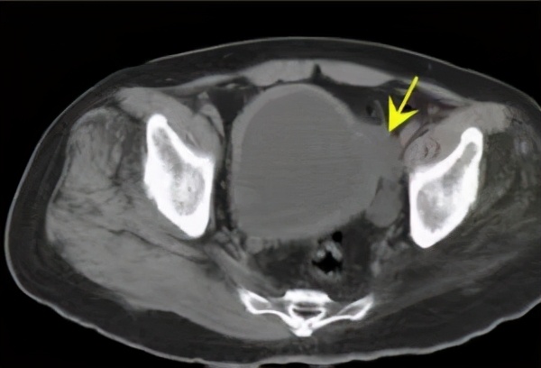 尿路造影输尿管间断显影,静脉尿路造影和排泄性尿路造影