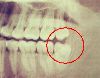 记录一次惨痛的拔牙经历,记一次愉快的拔牙经历