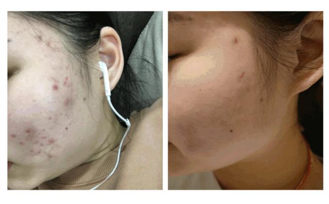 额头长闭口毛孔粗大爆痘怎么办,皮肤爆痘起闭口怎么回事