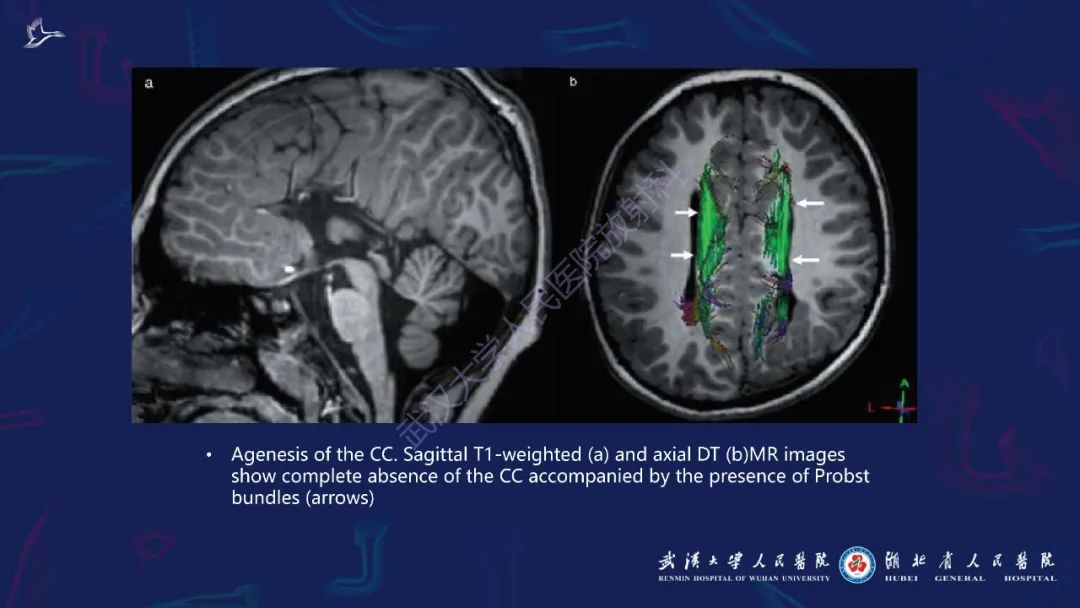 胼胝体肿瘤影像鉴别,胼胝体病变影像诊断