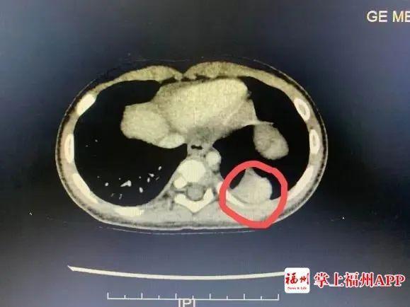 宝宝咳嗽伴有反复发烧福州,1岁8个月宝宝反复发烧肺部有痰
