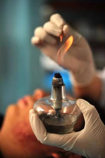 火疗引火烧身,引火归元针治疗三种病