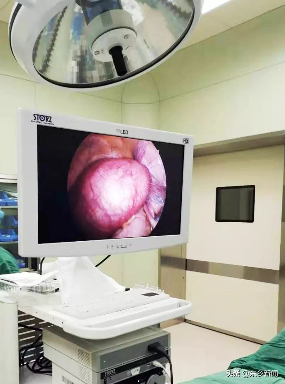 腹腔镜手术切除巨大卵巢囊肿,卵巢囊肿腹腔镜手术单孔