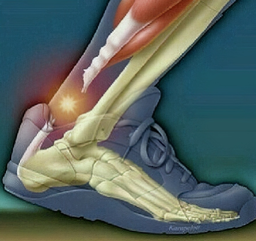 如何防止跟腱断裂和膝盖受伤,怎么避免跟腱断裂田径