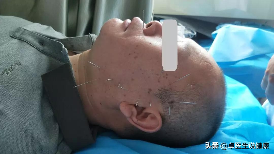 中医颊针案例分享:颈部包块20年,通过中医颊针疗法解决问题