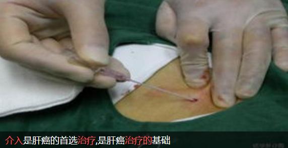 介入疗法的未来前景,介入治疗快速发展