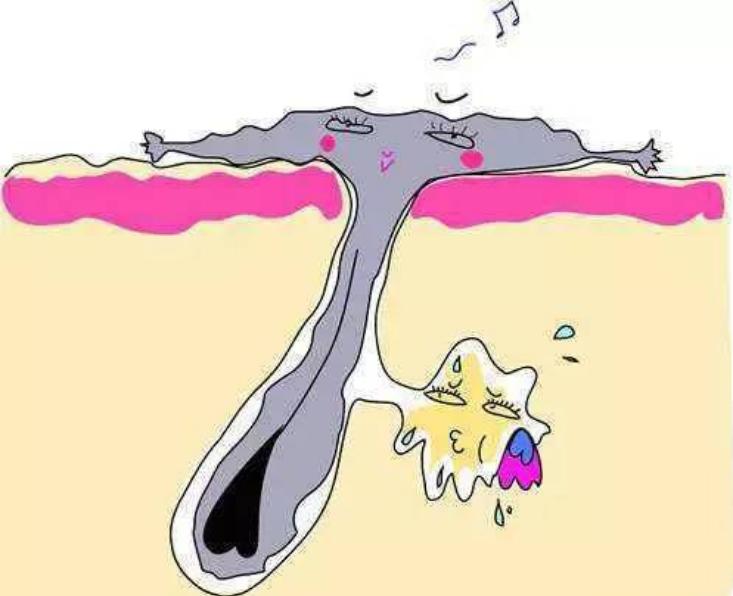 皮肤长斑长痘毛孔粗大的原因,皮肤毛孔粗大什么原因造成的