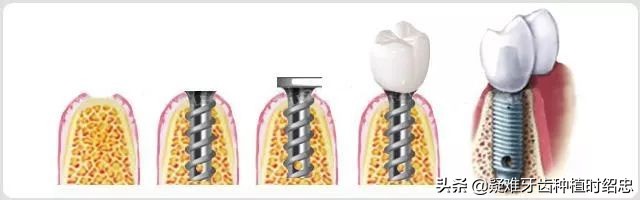 做种植牙必须要具备这些条件,种植牙的缺点哪些人不适合种植牙