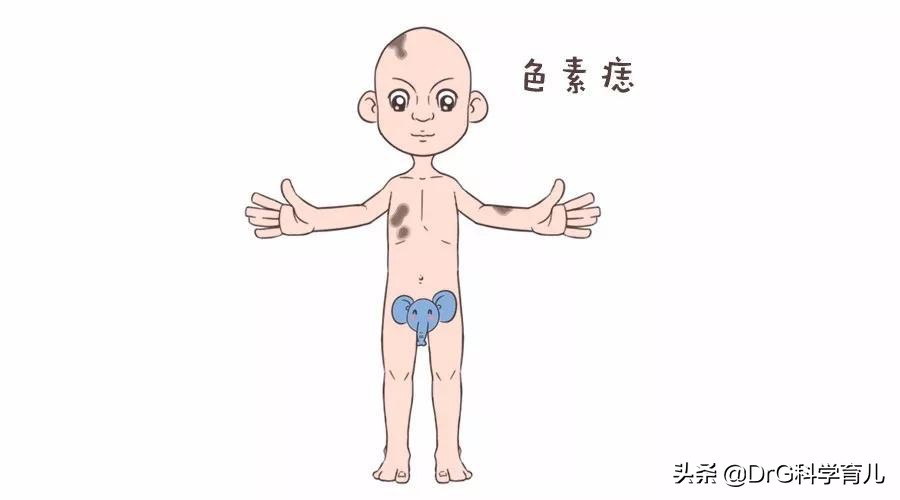 天生胎记黑毛痣会癌变会死吗,脖子上有个黑色胎记会癌变吗