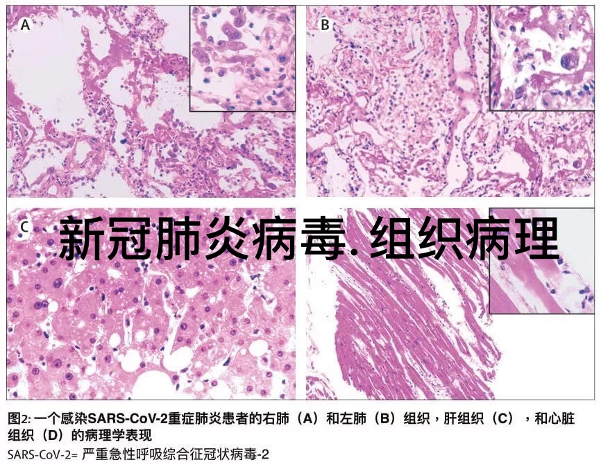 尸体解剖，曝露“新冠肺炎”恐怖背后的真相