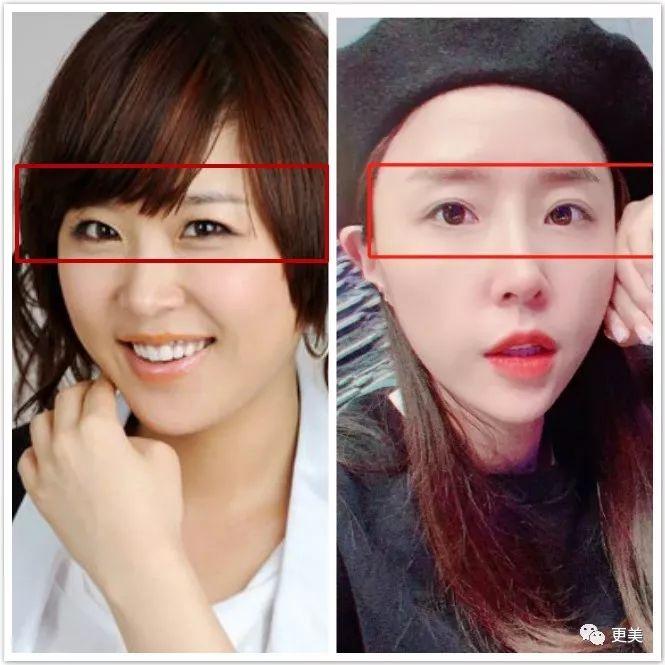 天后因队友吸du人气暴跌,公开承认整形却成蛇精下巴,瘦到脱相