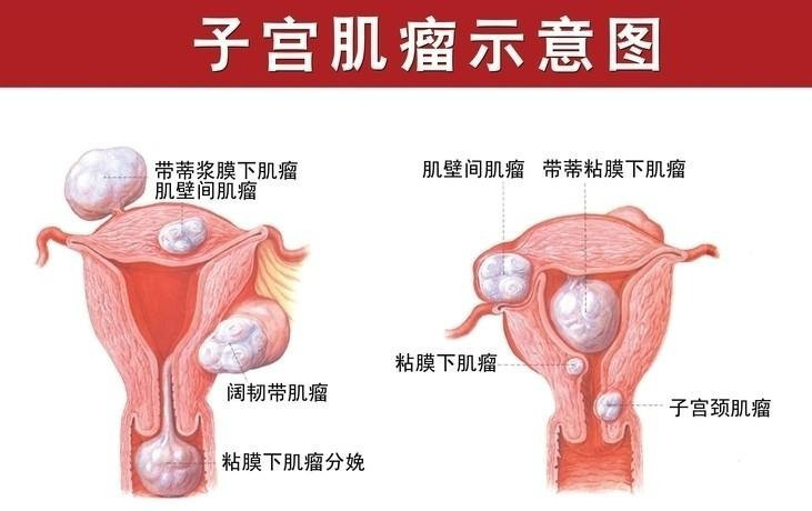 我48岁有子宫肌瘤停经半年又来了,我57岁子宫肌瘤6厘米需要怎么治疗